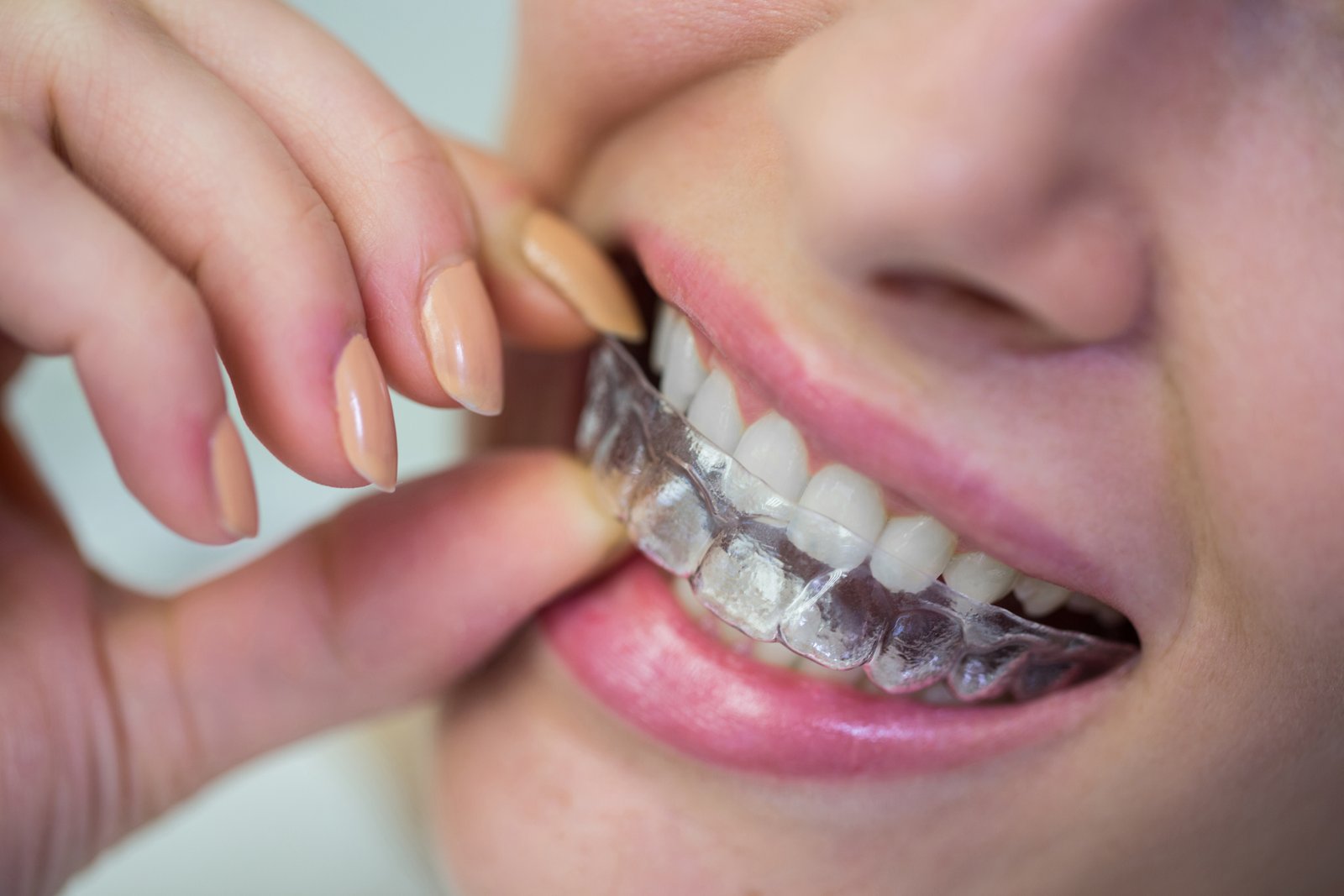 invisible tooth braces in Gujarat